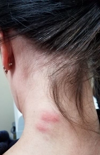 What do bed bug bites look like?